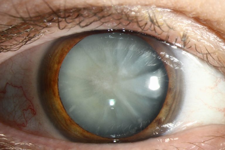 Qual é a fruta deliciosa que ajuda a prevenir o glaucoma, as cataratas nos olhos e elimina o colesterol «ruim»?