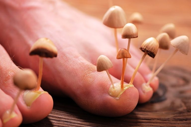 Remédio caseiro com água oxigenada para eliminar fungos e mau cheiro dos pés